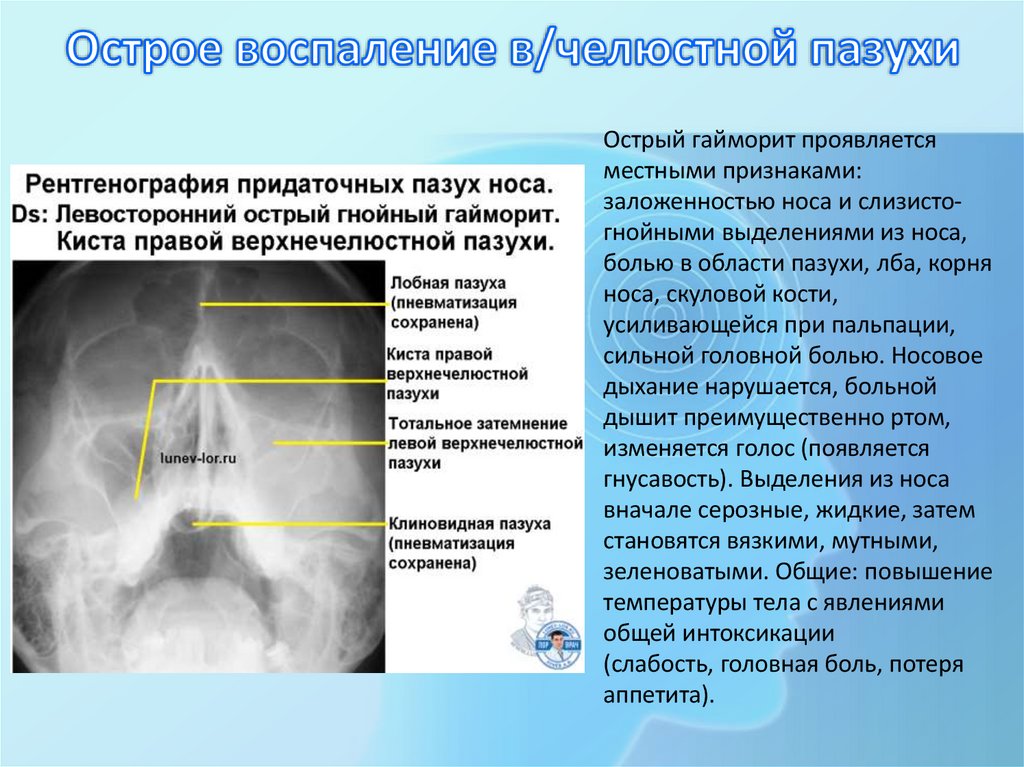 Острое воспаление в/челюстной пазухи