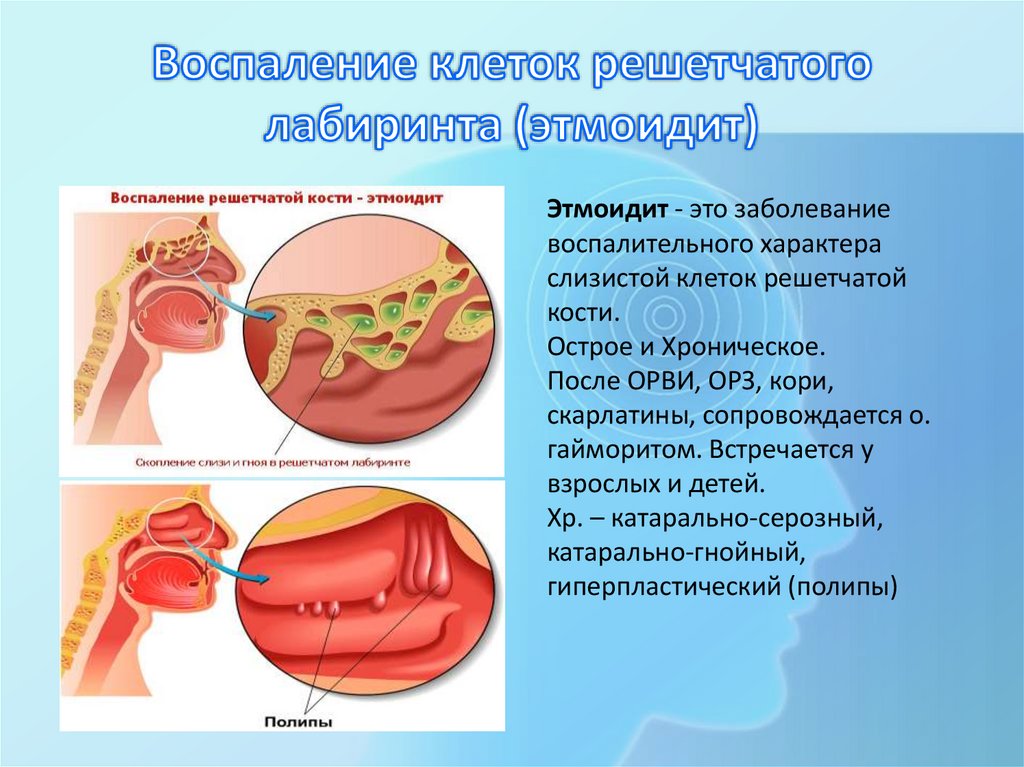 Воспаление клеток решетчатого лабиринта (этмоидит)