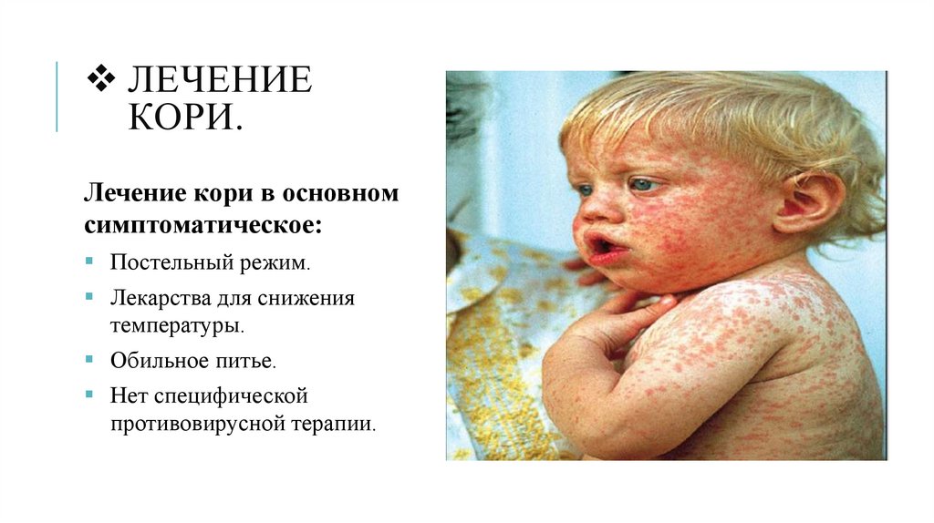 Лечение кори.