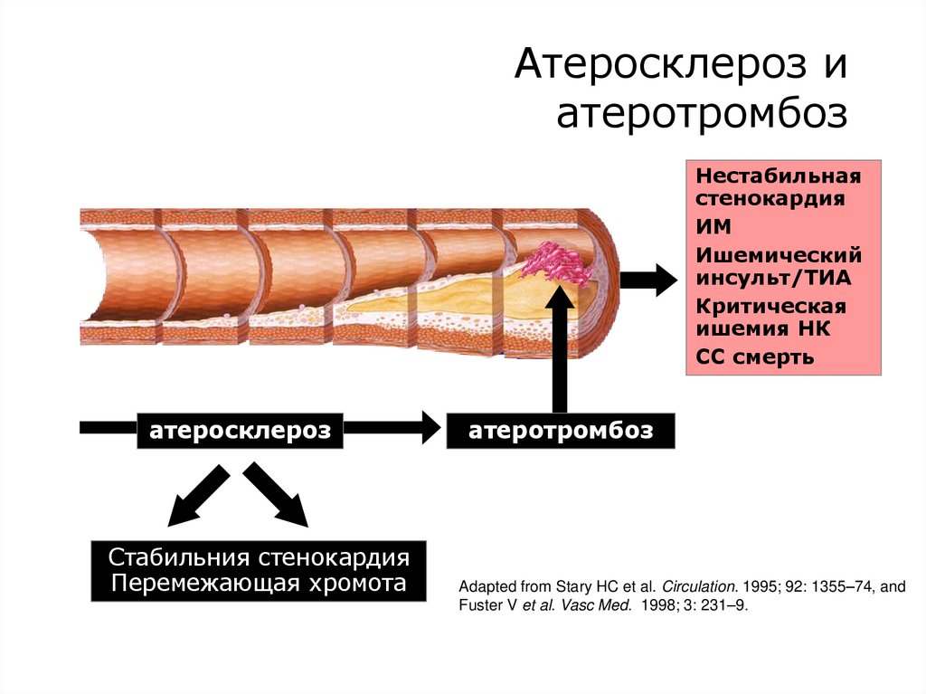 Атеросклероз и атеротромбоз
