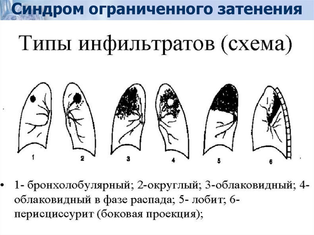 Синдром ограниченного затенения