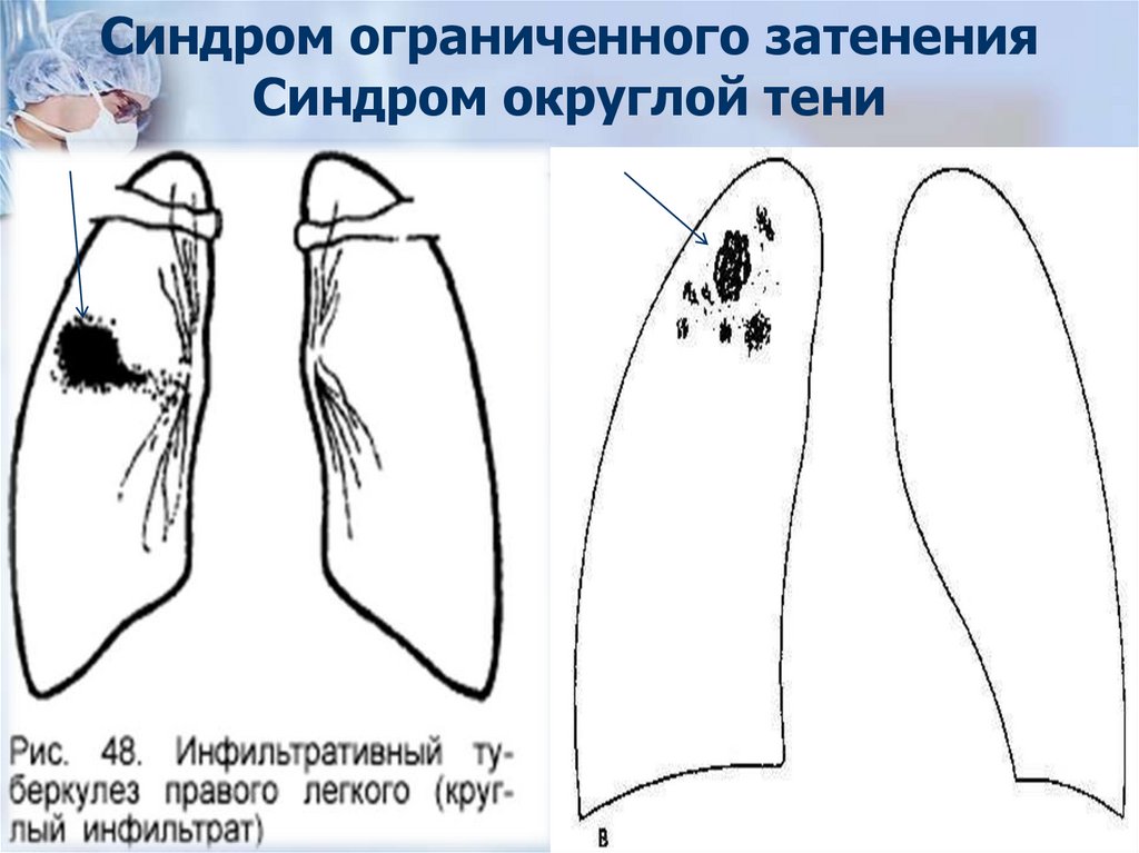 Синдром ограниченного затенения Синдром округлой тени