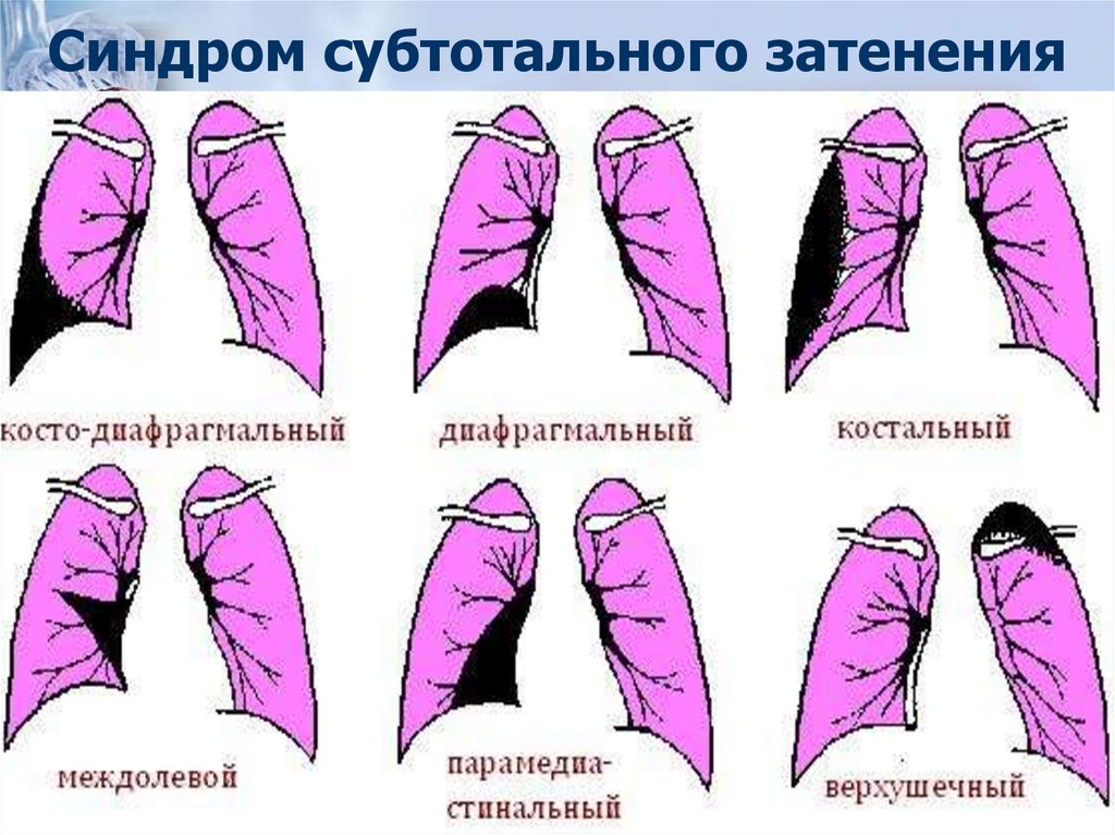 Синдром субтотального затенения