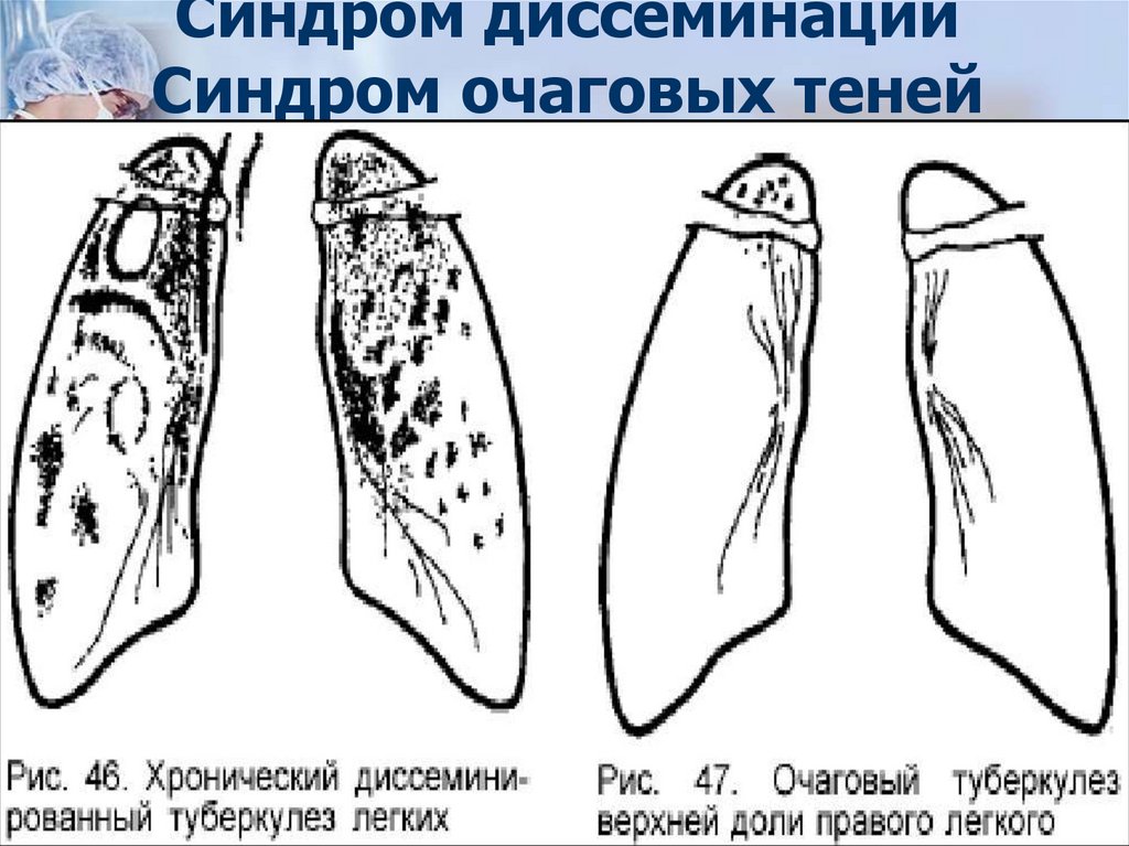 Синдром диссеминации Синдром очаговых теней