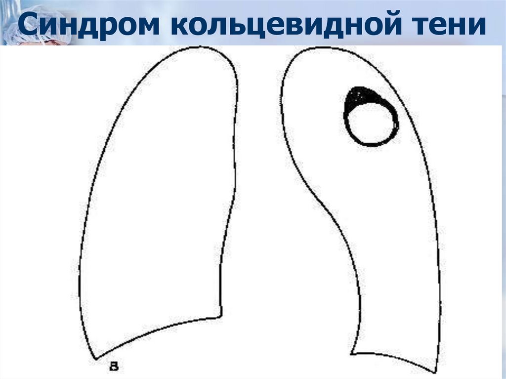 Синдром кольцевидной тени