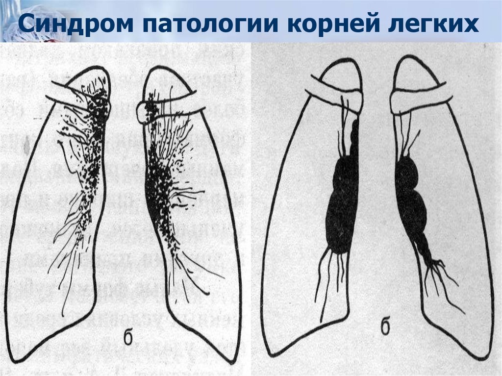 Синдром патологии корней легких