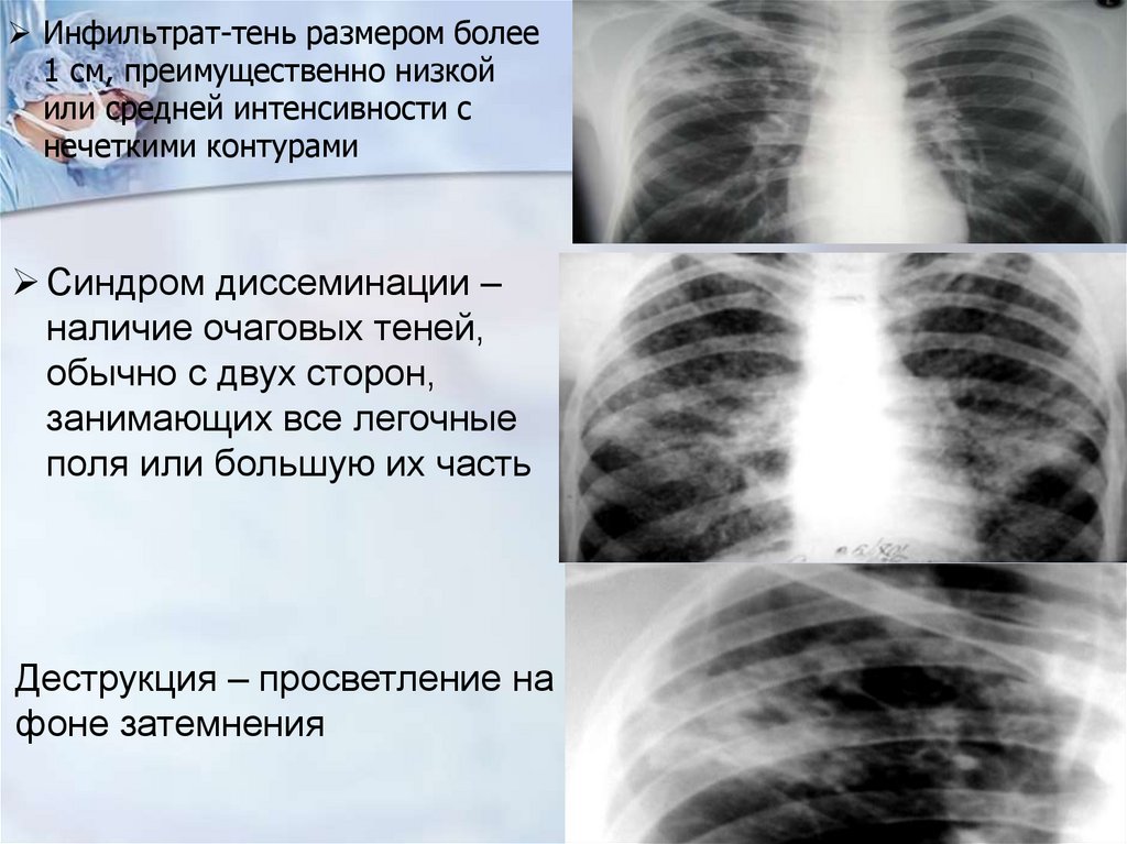 Инфильтрат-тень размером более 1 см, преимущественно низкой или средней интенсивности с нечеткими контурами