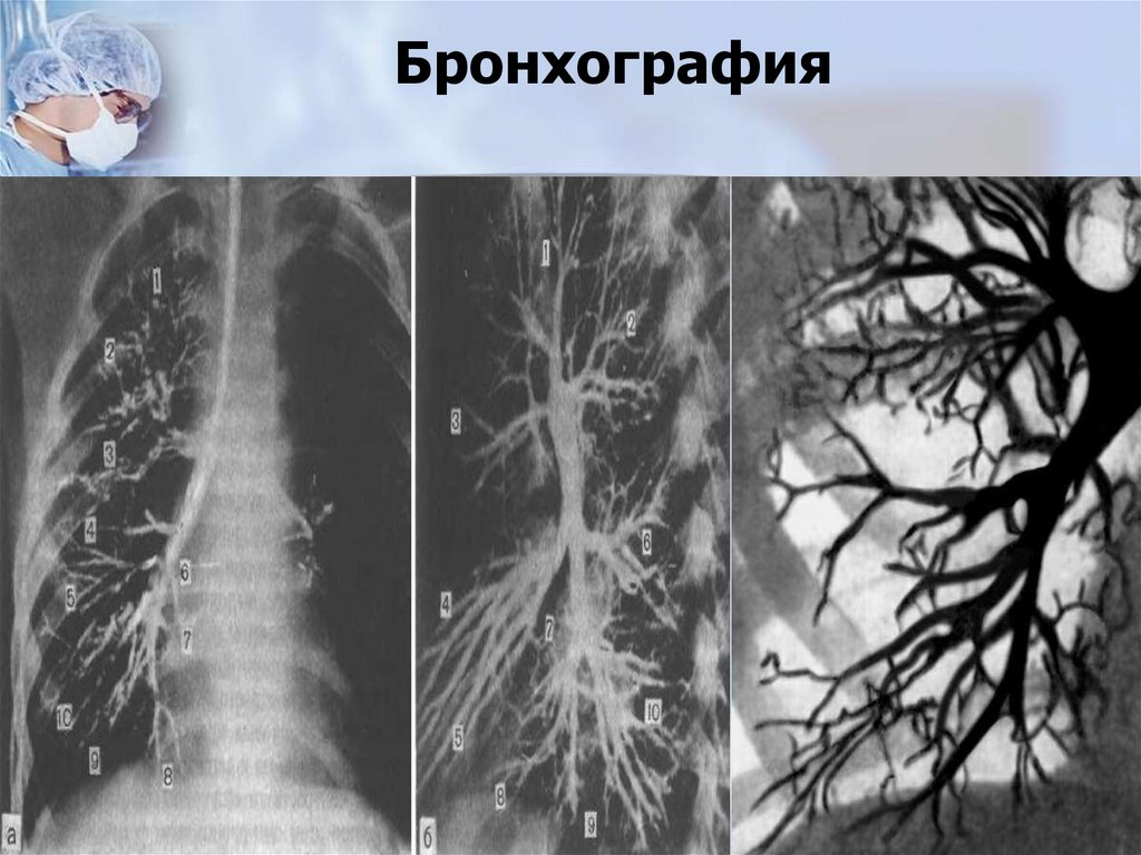 Бронхография