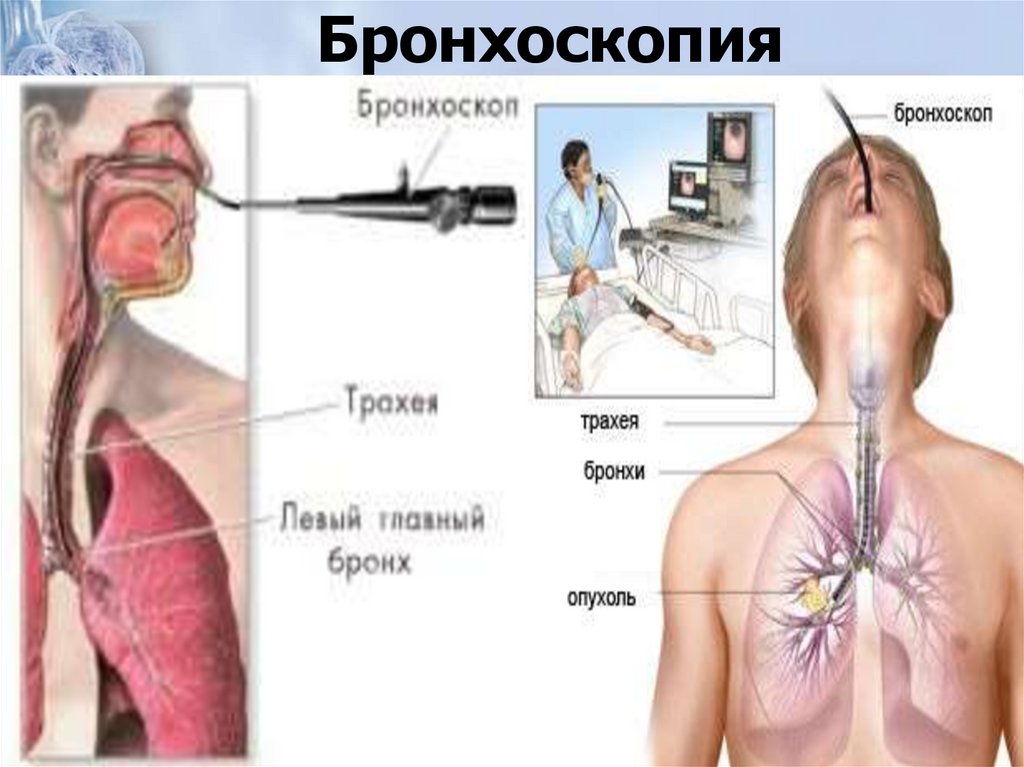 Бронхоскопия