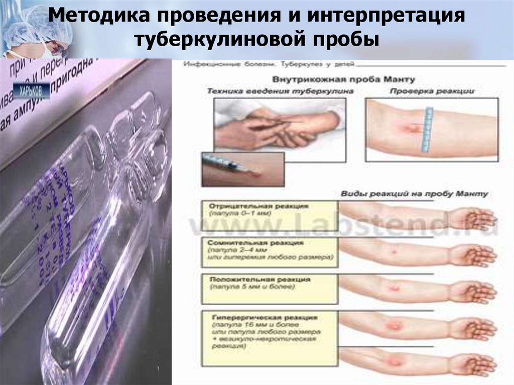 Методика проведения и интерпретация туберкулиновой пробы