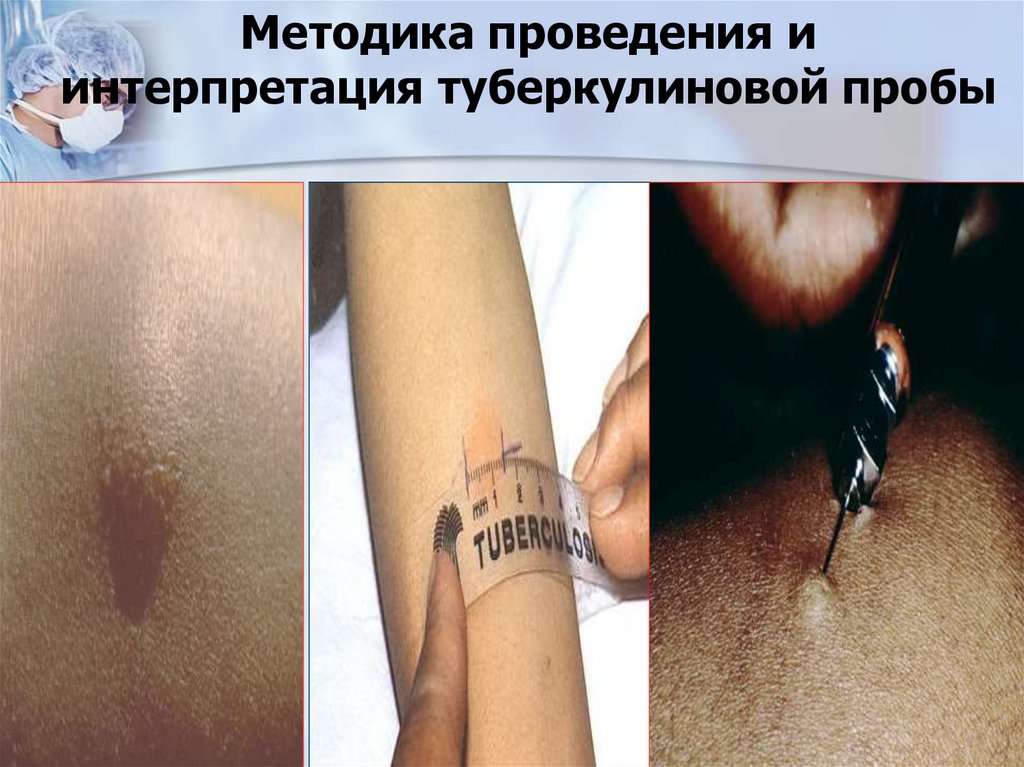 Методика проведения и интерпретация туберкулиновой пробы
