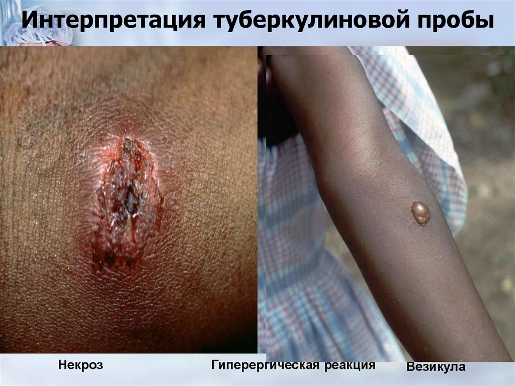 Интерпретация туберкулиновой пробы