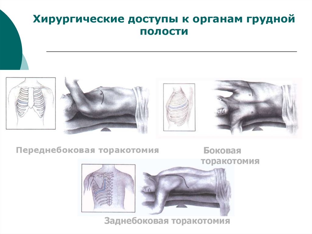 Хирургические доступы к органам грудной полости