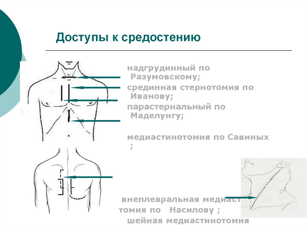 Доступы к средостению