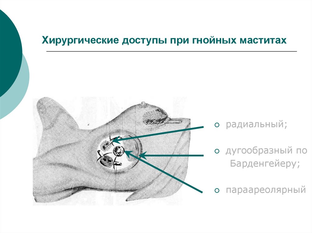 Хирургические доступы при гнойных маститах