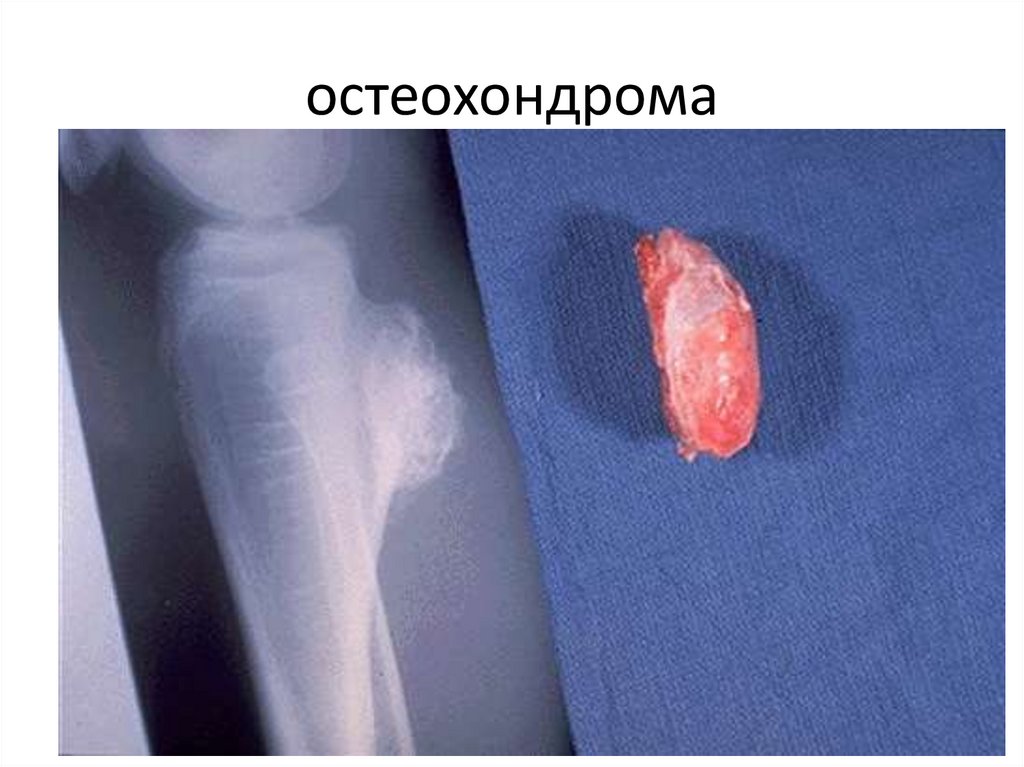 остеохондрома