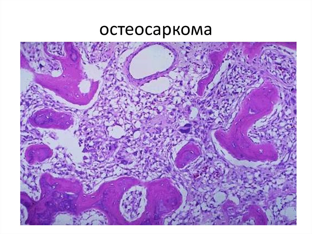 остеосаркома