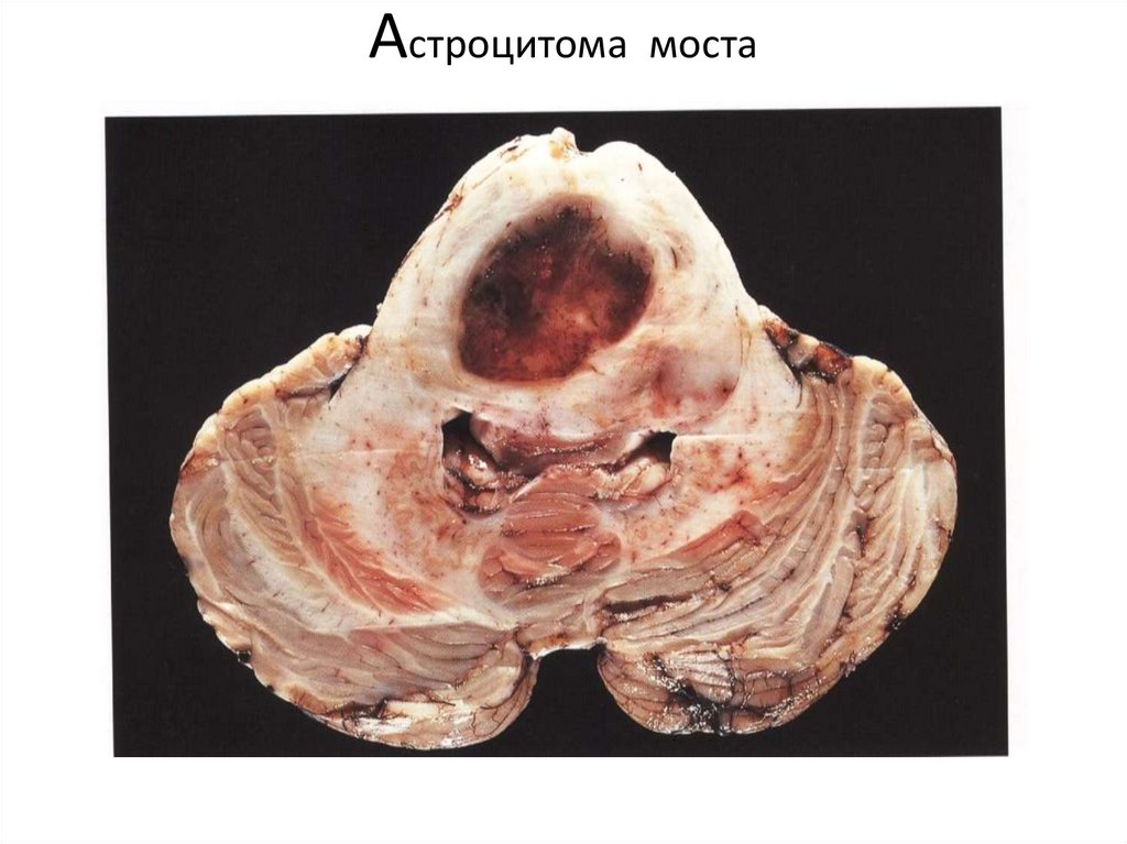 Астроцитома моста