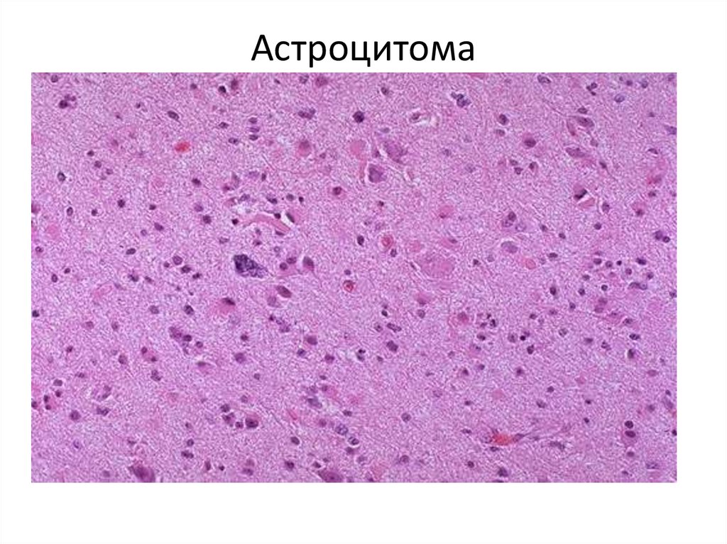 Астроцитома
