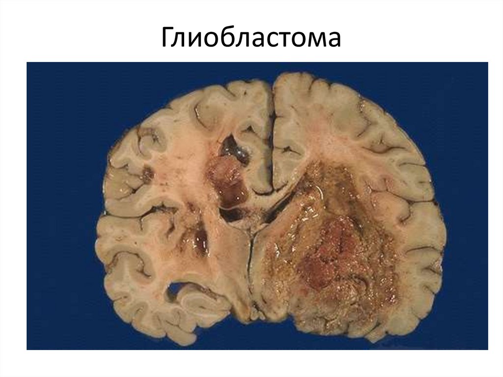 Глиобластома