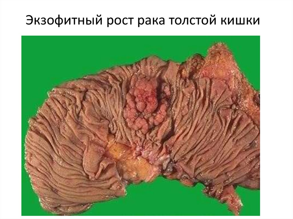 Экзофитный рост рака толстой кишки