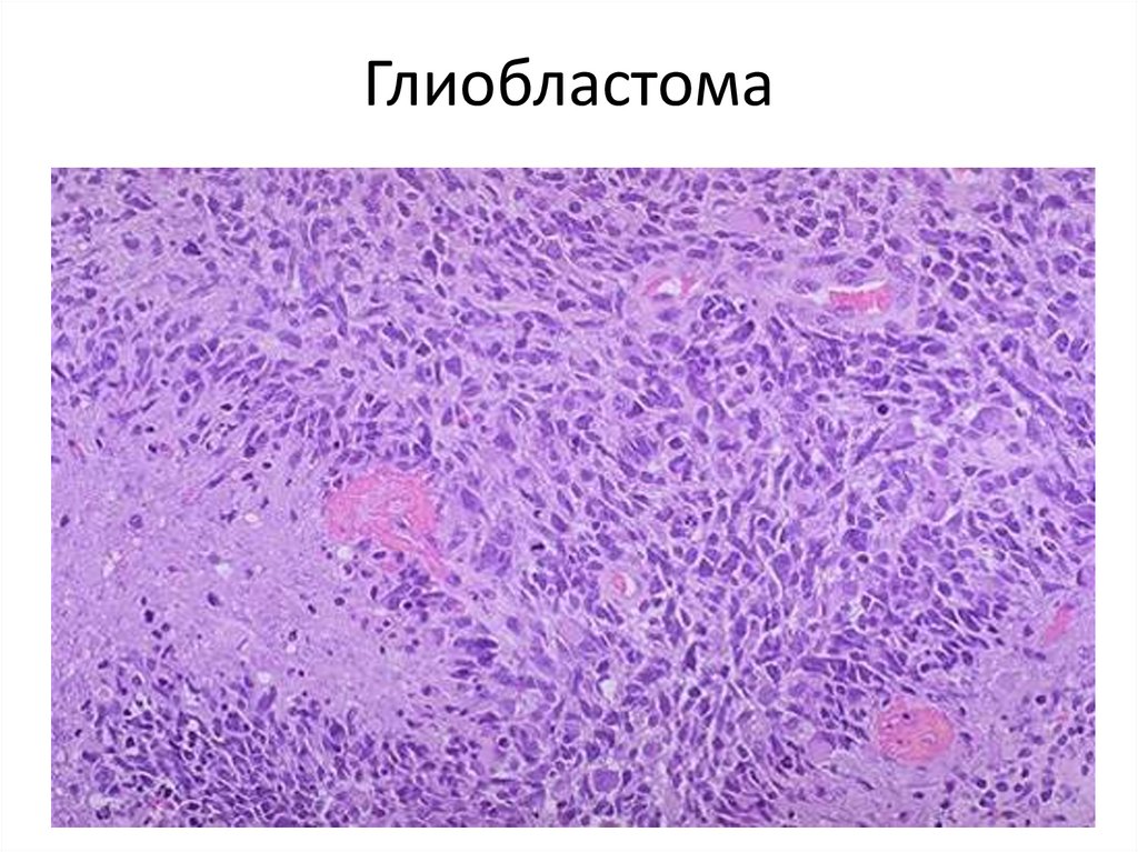 Глиобластома