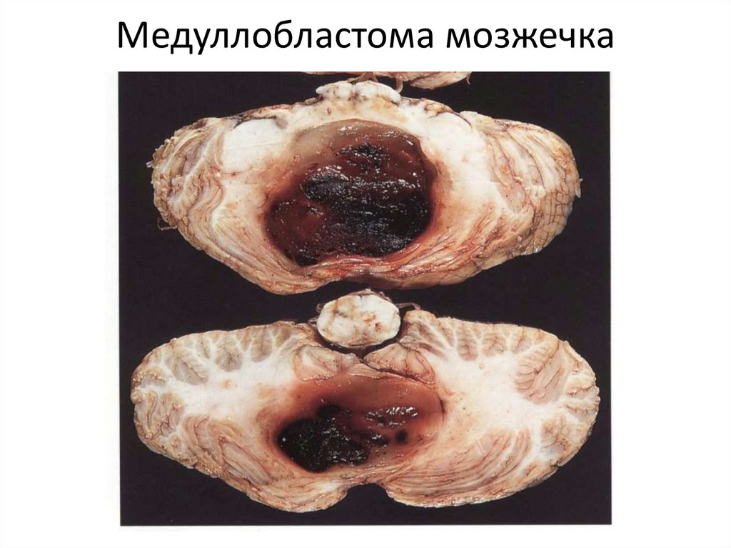 Медуллобластома мозжечка