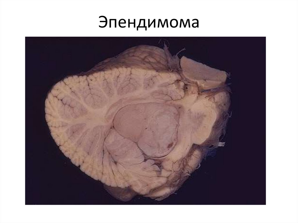 Эпендимома