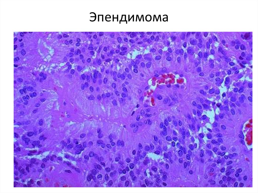 Эпендимома