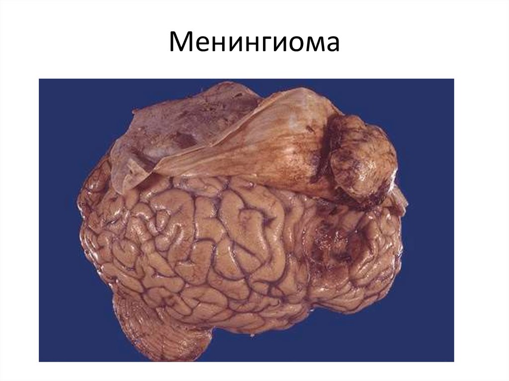 Менингиома