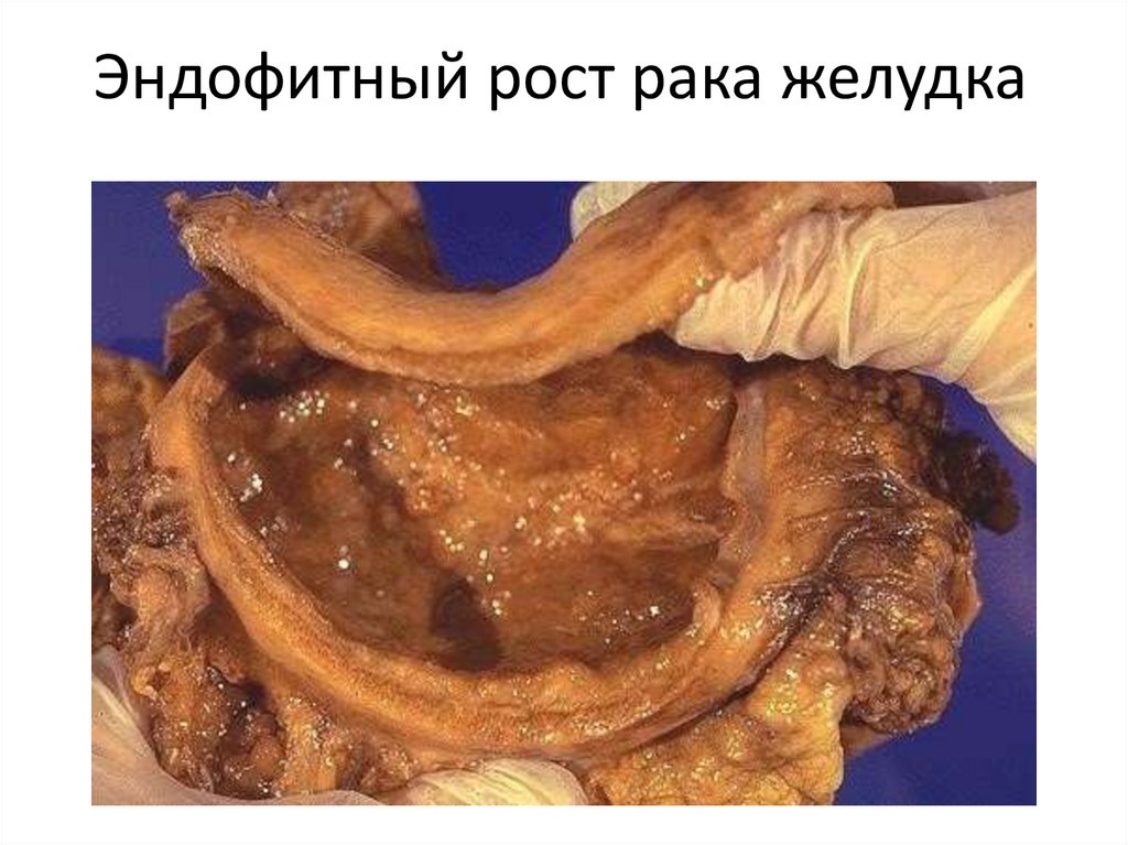 Эндофитный рост рака желудка