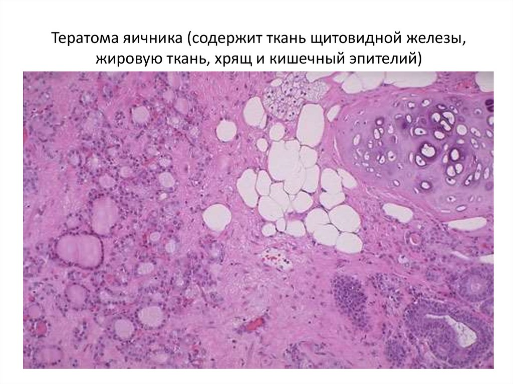 Тератома яичника (содержит ткань щитовидной железы, жировую ткань, хрящ и кишечный эпителий)