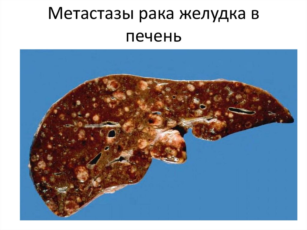 Метастазы рака желудка в печень
