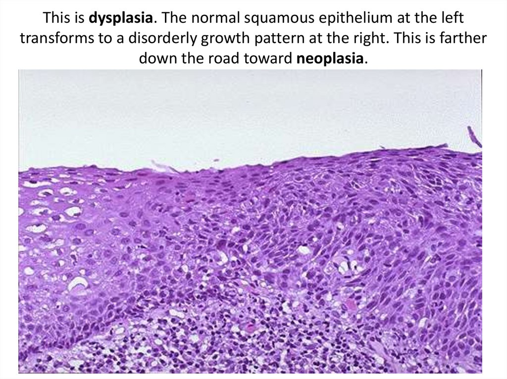 This is dysplasia. The normal squamous epithelium at the left transforms to a disorderly growth pattern at the right. This is