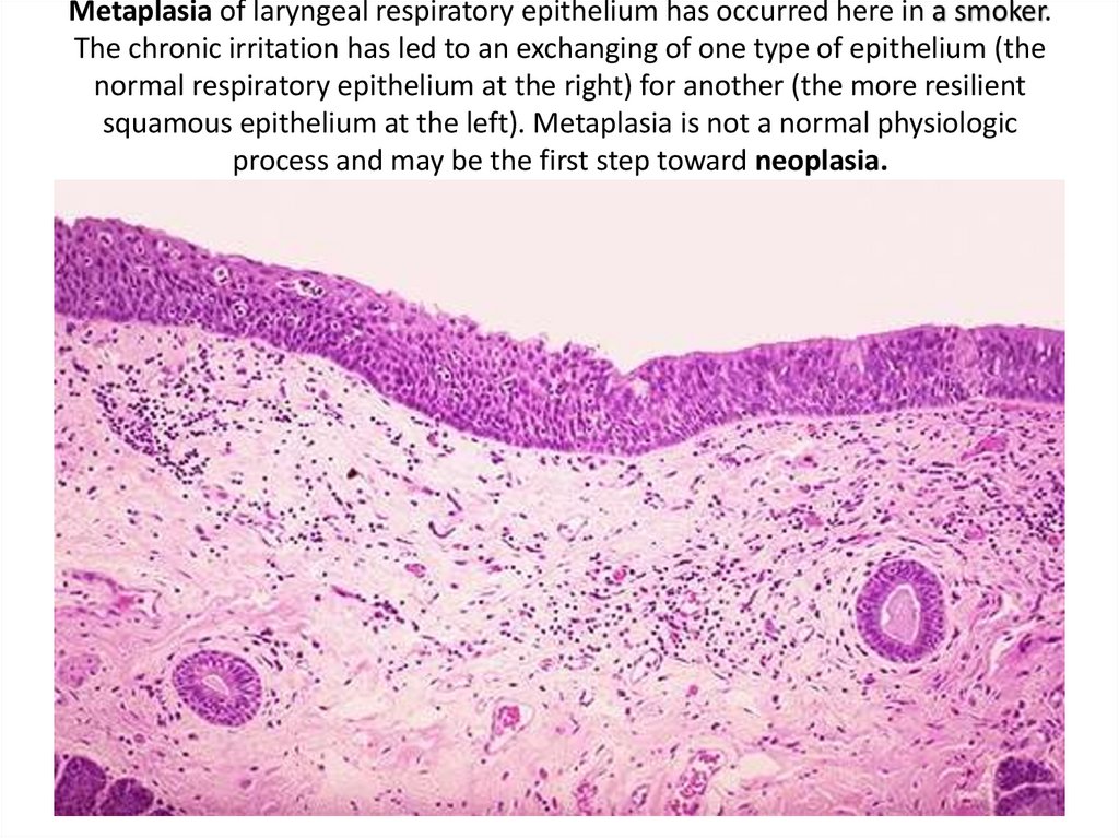 Metaplasia of laryngeal respiratory epithelium has occurred here in a smoker. The chronic irritation has led to an exchanging