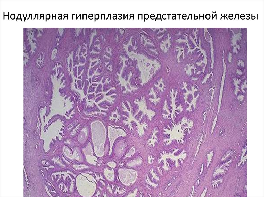 Нодуллярная гиперплазия предстательной железы