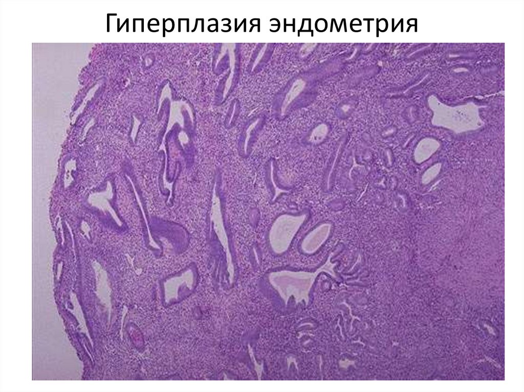 Гиперплазия эндометрия