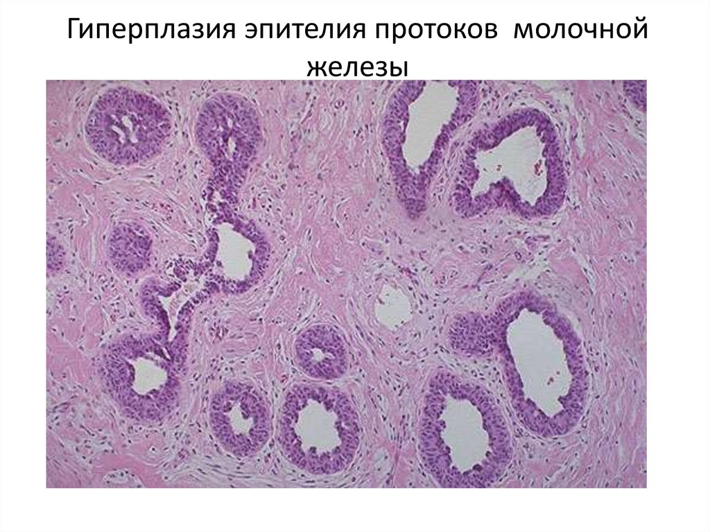 Гиперплазия эпителия протоков молочной железы