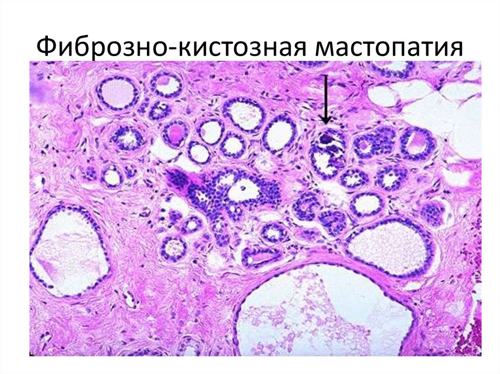Фиброзно-кистозная мастопатия