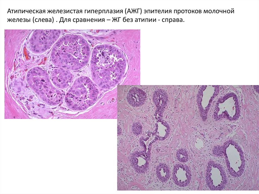 Атипическая железистая гиперплазия (АЖГ) эпителия протоков молочной железы (слева) . Для сравнения – ЖГ без атипии - справа.