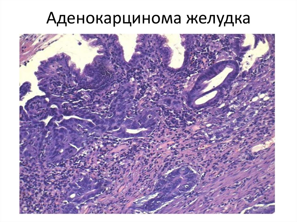 Аденокарцинома желудка