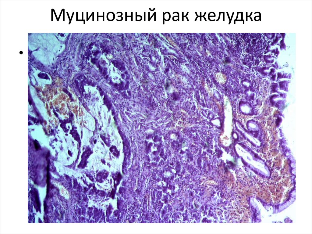 Муцинозный рак желудка