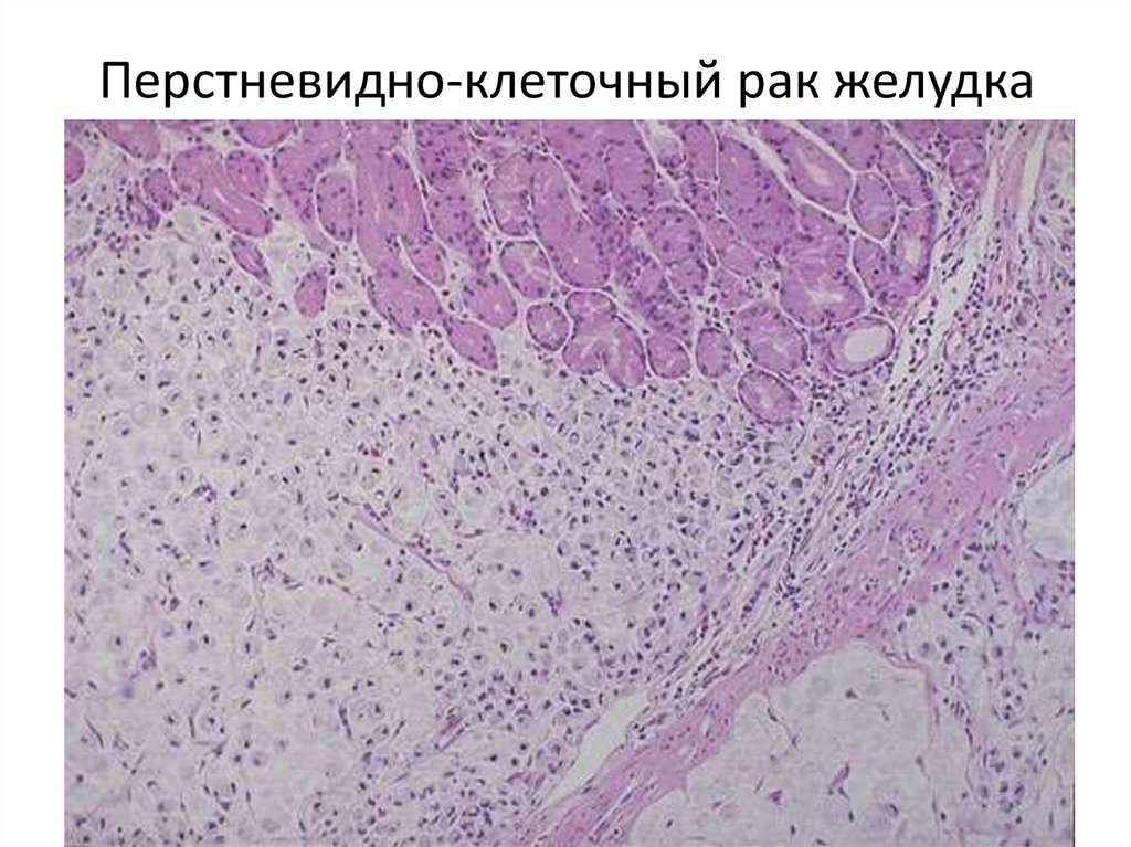 Перстневидно-клеточный рак желудка