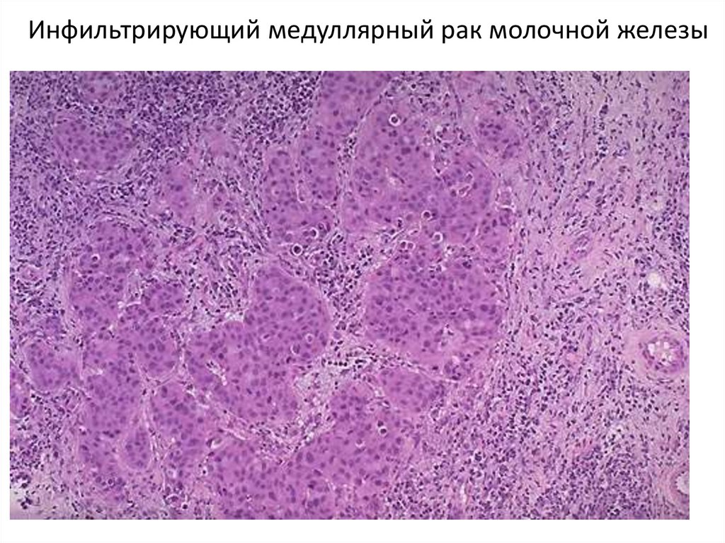 Инфильтрирующий медуллярный рак молочной железы