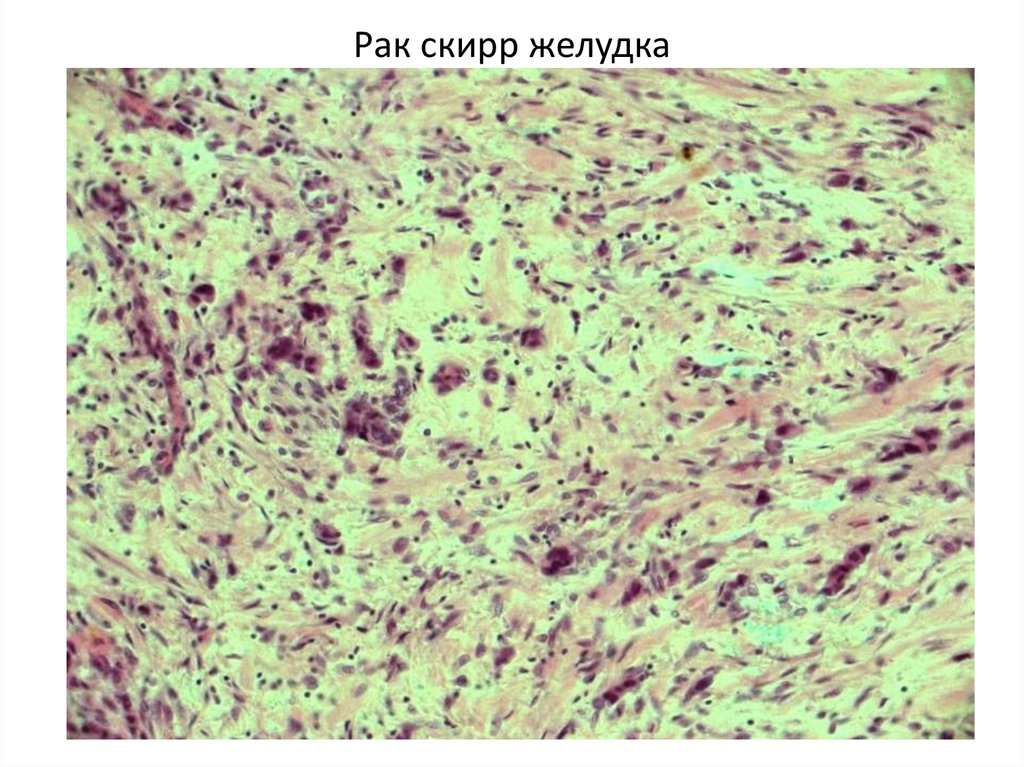 Рак скирр желудка