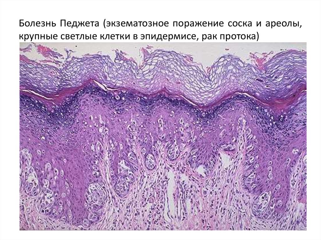 Болезнь Педжета (экзематозное поражение соска и ареолы, крупные светлые клетки в эпидермисе, рак протока)