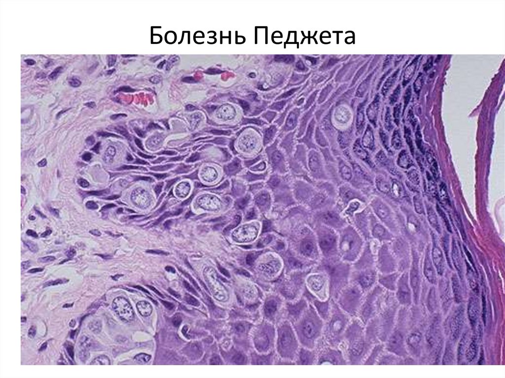 Болезнь Педжета