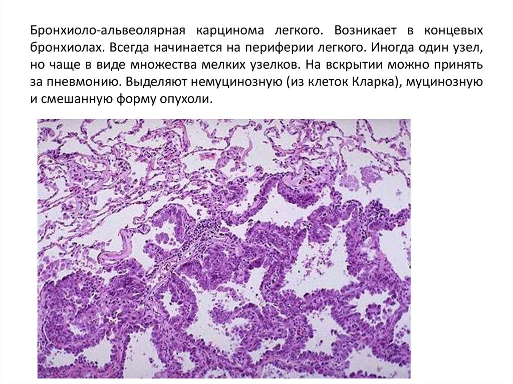 Бронхиоло-альвеолярная карцинома легкого. Возникает в концевых бронхиолах. Всегда начинается на периферии легкого. Иногда один