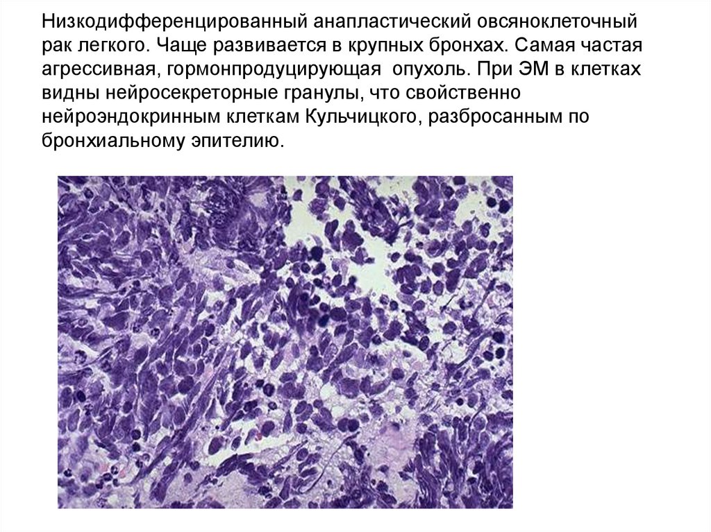 Низкодифференцированный анапластический овсяноклеточный рак легкого. Чаще развивается в крупных бронхах. Самая частая