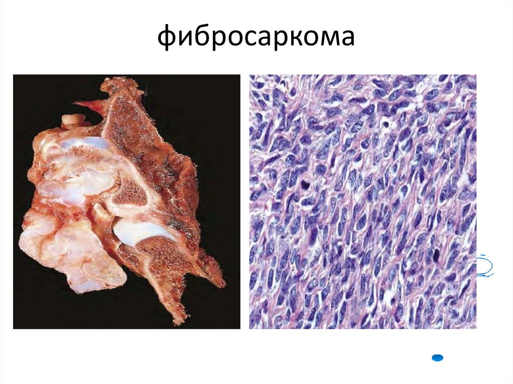 фибросаркома